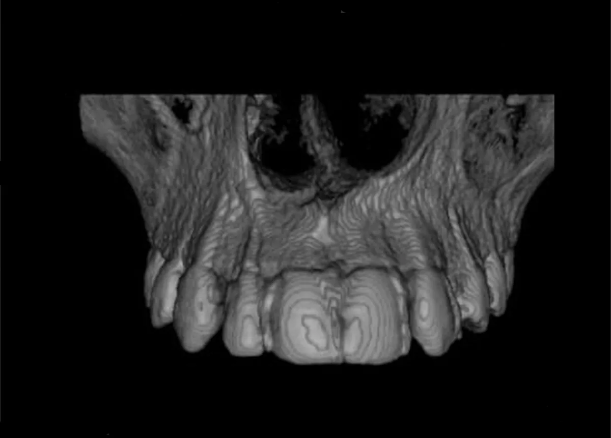 Reconstrução 3D de tomografia Cone Beam em escala de cinza