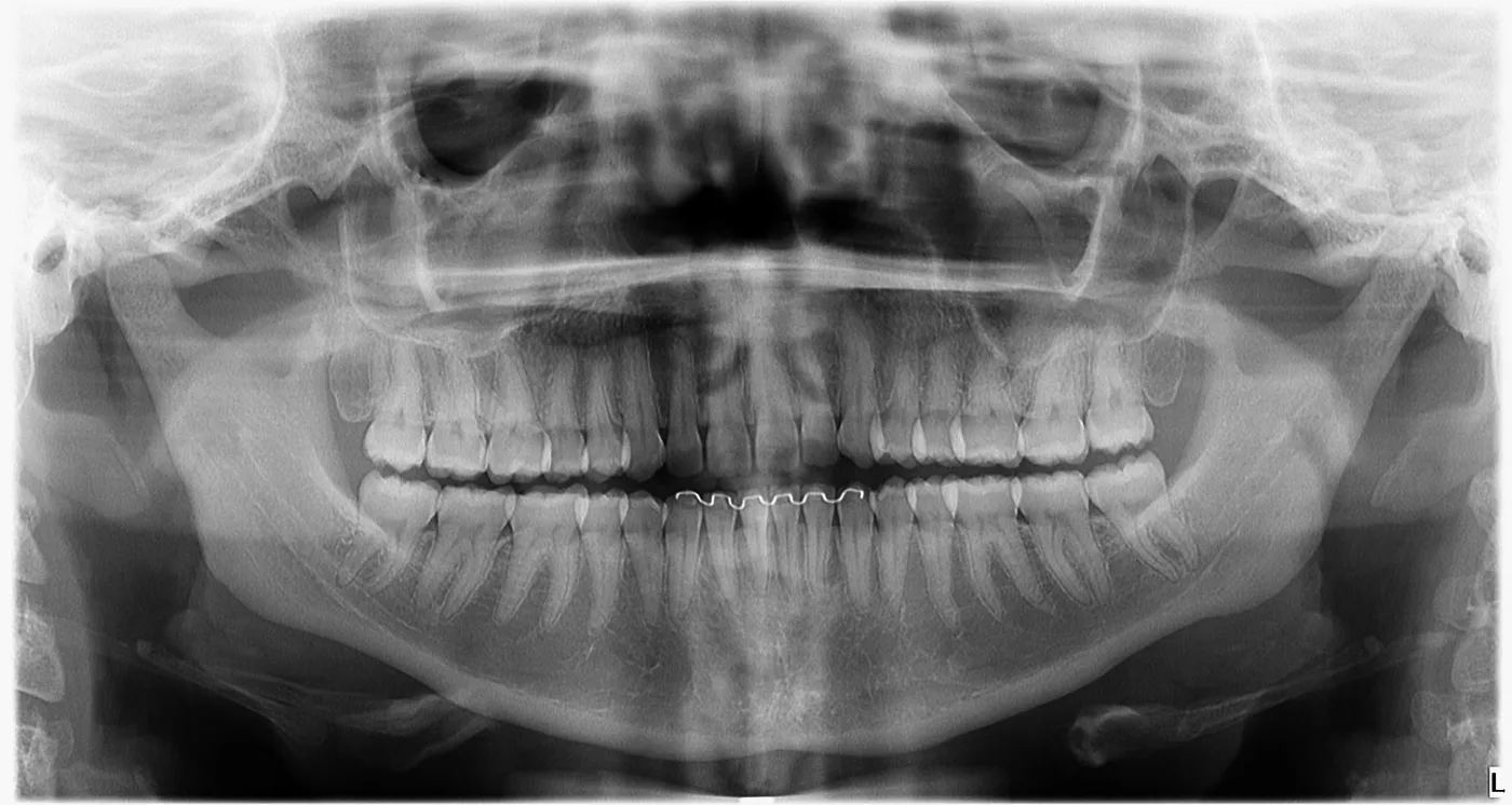 Radiografia panorâmica dos maxilares e dentes