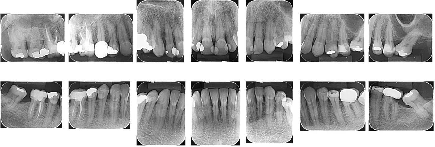 Série de radiografias periapicais da boca toda