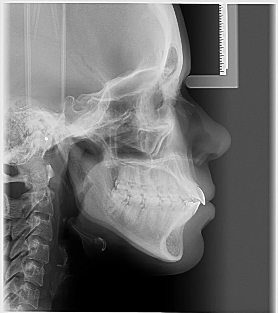 Telerradiografia lateral do crânio com régua de calibração