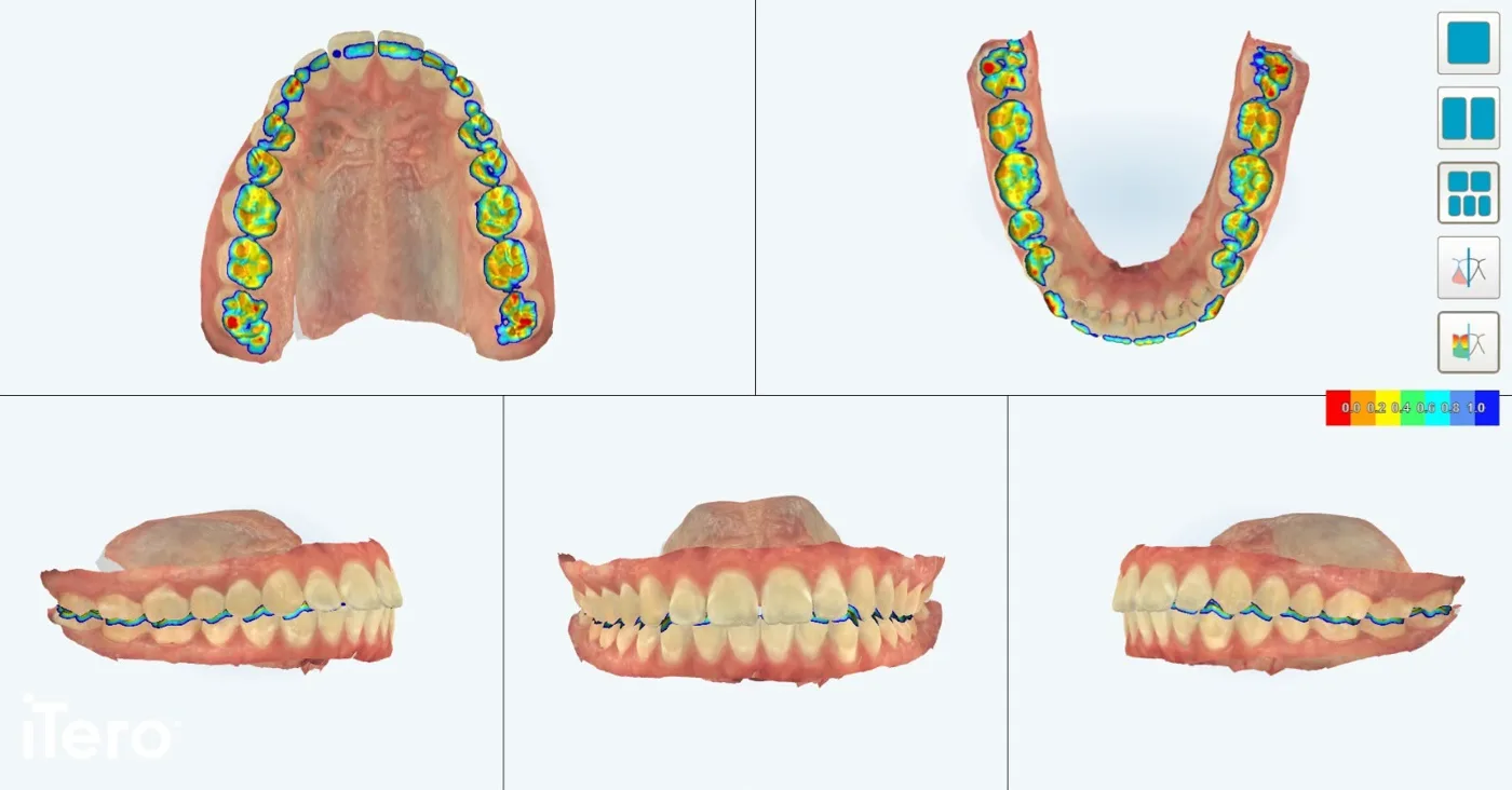 Modelos digitais das arcadas superior e inferior obtidos por escaneamento intraoral